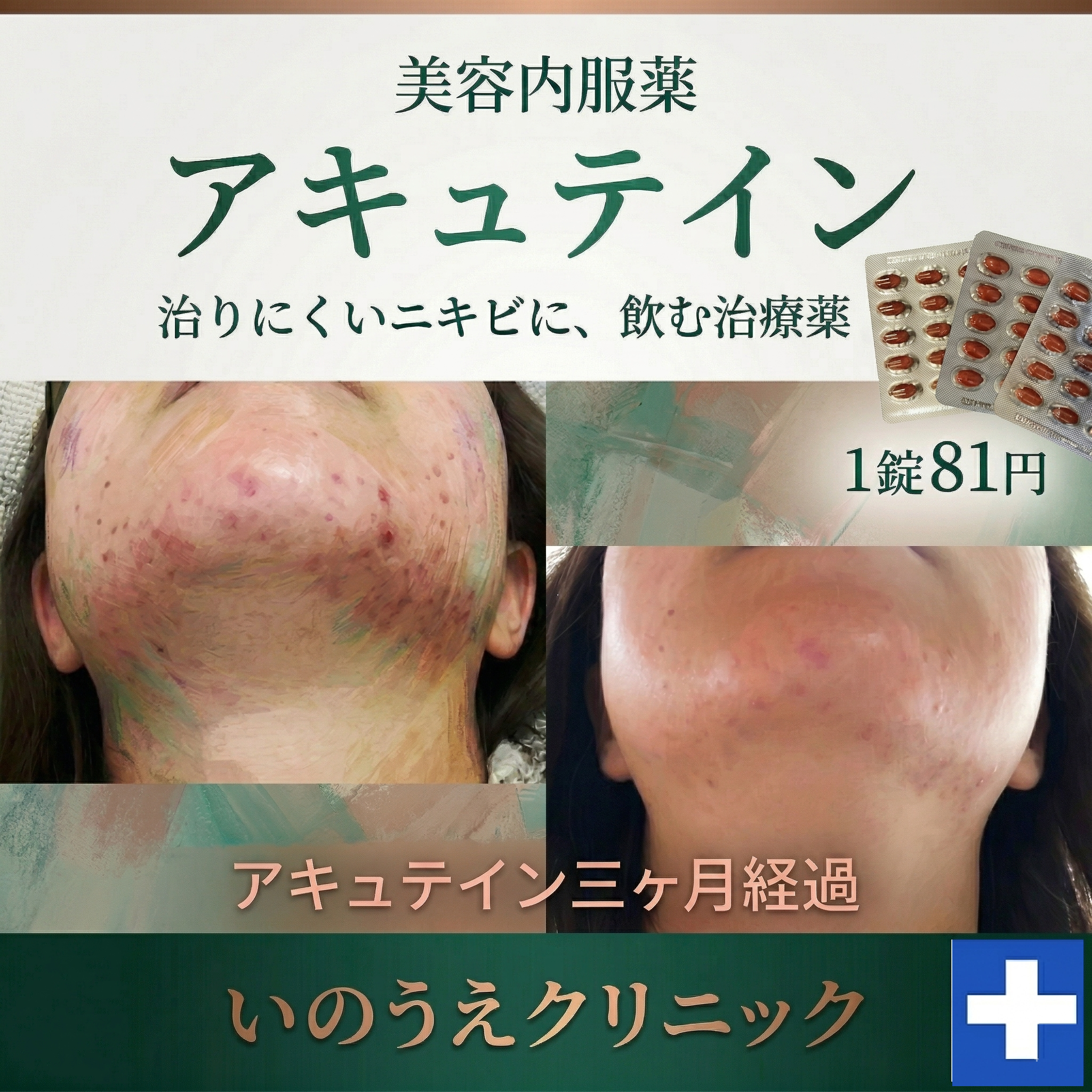 美容内服薬 アキュテイン 治りにくいニキビに、飲む治療薬 1錠81円 いのうえクリニック